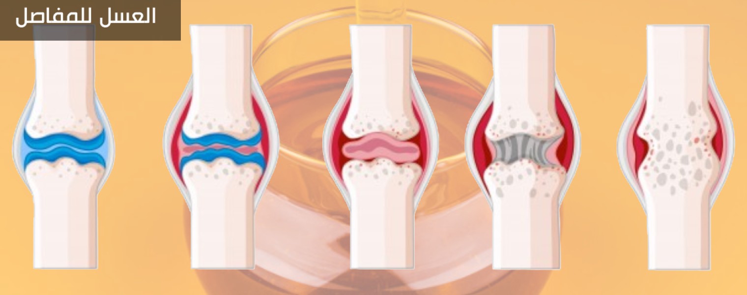 هل يفيد العسل في علاج التهاب المفاصل... تعرف على فوائد العسل لالتهاب المفاصل