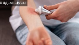 6 علاجات منزلية لعلاج لسعات النحل